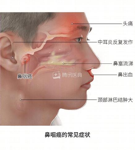 癌症鼻炎