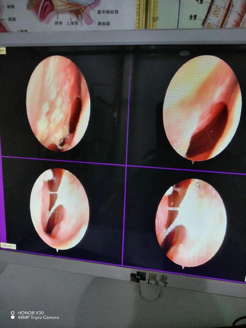 鼻内镜检查