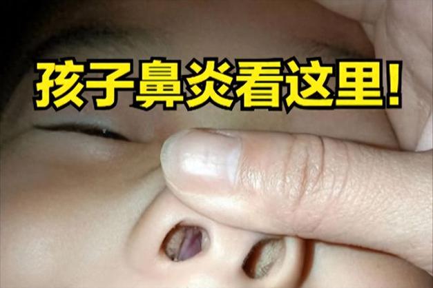 小宝宝鼻炎有哪些常见症状？