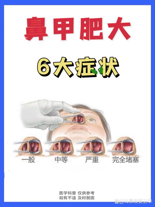 鼻塞加重