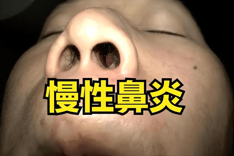 青年鼻炎 ？真的能根治吗？