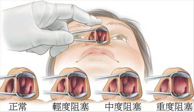 濞立迪能治疗过敏性鼻炎吗？