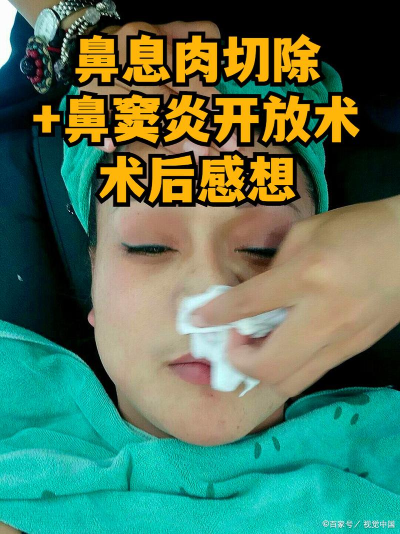 哪些鼻炎需要进行手术治疗？