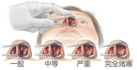 鼻腔分泌物倒流